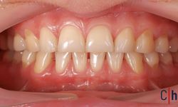 Diş Eti Çekilmesi: Önlemek İçin Doğal Yöntemler Nelerdir?