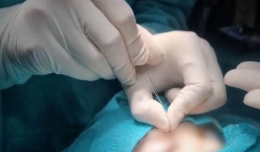 Gözyaşı Kanalı Tedavisi Artık Hakkari'de Yapılıyor